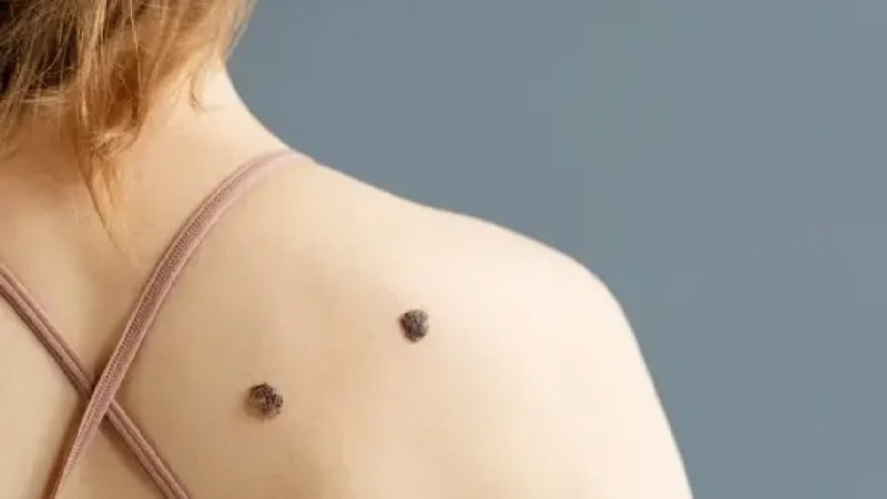 Penyebab dan Cara Menghilangkan Skin Tag dengan Aman – PAFI Muara Sabak